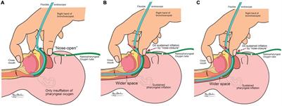 Flexible Endoscopy With Non-invasive Ventilation Enables Clinicians to Assess and Manage Infants With Severe Bronchopulmonary Dysplasia